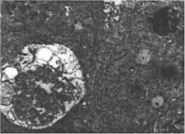 图1 凋亡细胞电镜照片( 12000×